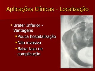 Aplicações Clínicas - Localização Ureter Inferior - Vantagens Pouca hospitalização Não invasiva Baixa taxa de complicação 