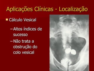 Aplicações Clínicas - Localização Cálculo Vesical Altos índices de sucesso Não trata a obstrução do colo vesical 