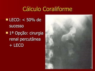Cálculo Coraliforme LECO: < 50% de sucesso 1ª Opção: cirurgia renal percutânea + LECO 