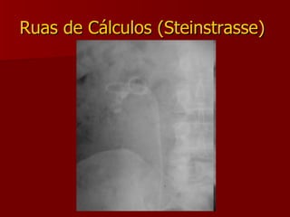 Ruas de Cálculos (Steinstrasse)  