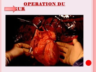 OPERATION DU
COEUR
 