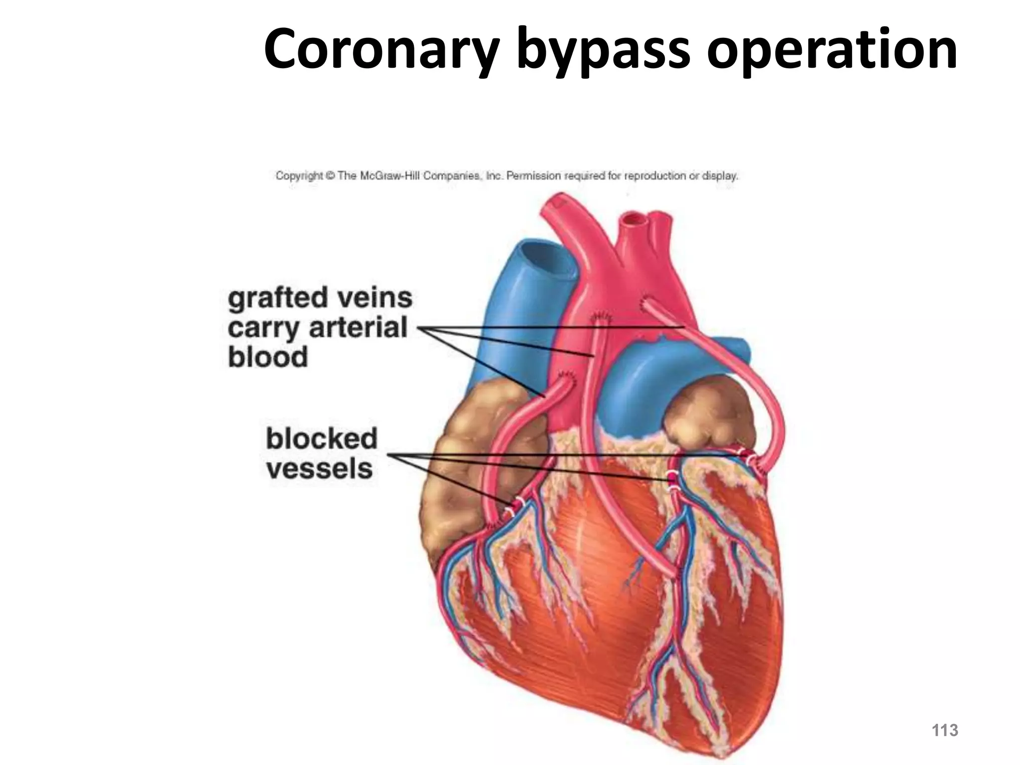 Coronary bypass operation 
DVM.PHD Firas hayajneh 113 
 