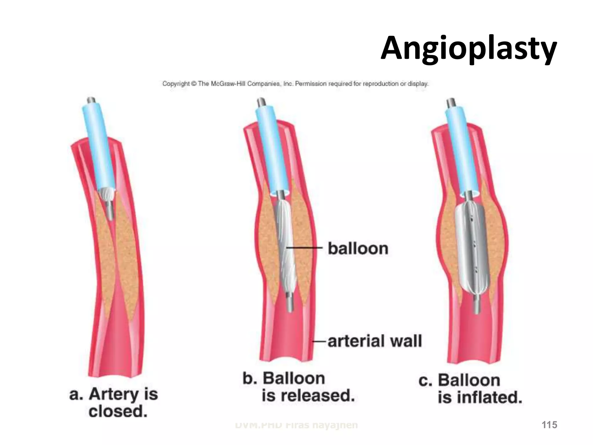 Angioplasty 
DVM.PHD Firas hayajneh 115 
 