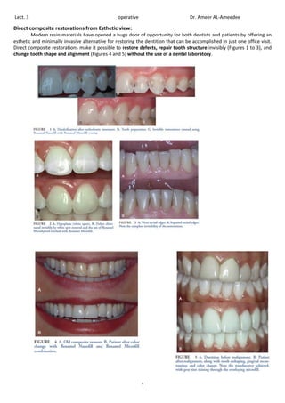 1
Lect. 3 operative Dr. Ameer AL-Ameedee
Direct composite restorations from Esthetic view:
Modern resin materials have opened a huge door of opportunity for both dentists and patients by offering an
esthetic and minimally invasive alternative for restoring the dentition that can be accomplished in just one office visit.
Direct composite restorations make it possible to restore defects, repair tooth structure invisibly (Figures 1 to 3), and
change tooth shape and alignment (Figures 4 and 5) without the use of a dental laboratory.
 