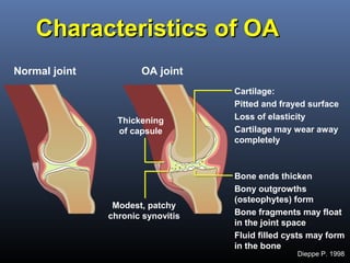 Oesteoarthritis | PPT
