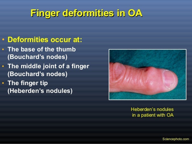 Heberden Nodes Treatment Naturally Heberden Nodes Treatment Naturally