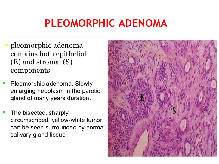 pleomorphic adenoma