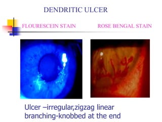 DENDRITIC ULCER
FLOURESCEIN STAIN ROSE BENGAL STAIN
Ulcer –irregular,zigzag linear
branching-knobbed at the end
 