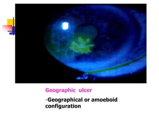 Geographic ulcer
-Geographical or amoeboid
configuration
 