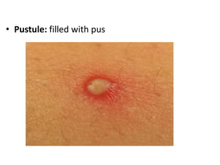 Pustule Remove Lect 2 integumentary system | PPTX