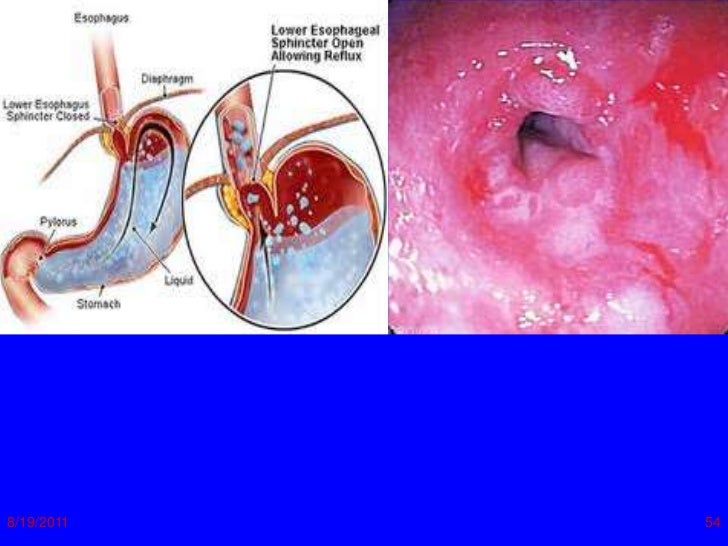 Lect.3.diseases of esophagus