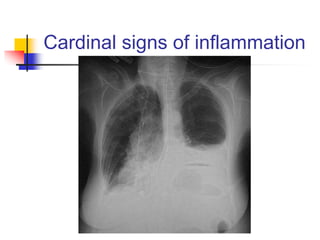 Cardinal signs of inflammation
 