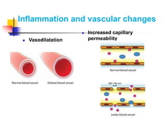 Inflammation and vascular changes
 Vasodilatation
 Increased capillary
permeability
Normal blood vessel Dilated blood vessel
Normal blood vessel
Leaky blood vessel
 