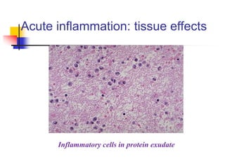 Acute inflammation: tissue effects
Inflammatory cells in protein exudate
 