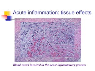 Acute inflammation: tissue effects
Blood vessel involved in the acute inflammatory process
 