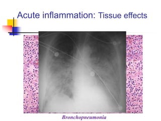 Acute inflammation: Tissue effects
Bronchopneumonia
 