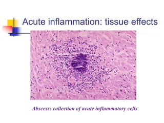 Acute inflammation: tissue effects
Abscess: collection of acute inflammatory cells
 