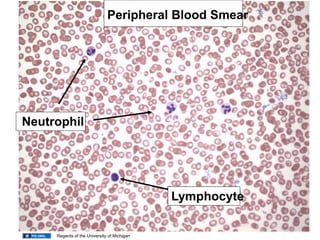 Peripheral Blood Smear
Neutrophil
Lymphocyte
Regents of the University of Michigan
 