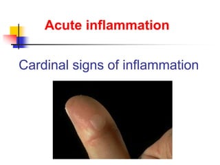 Cardinal signs of inflammation
Acute inflammation
 