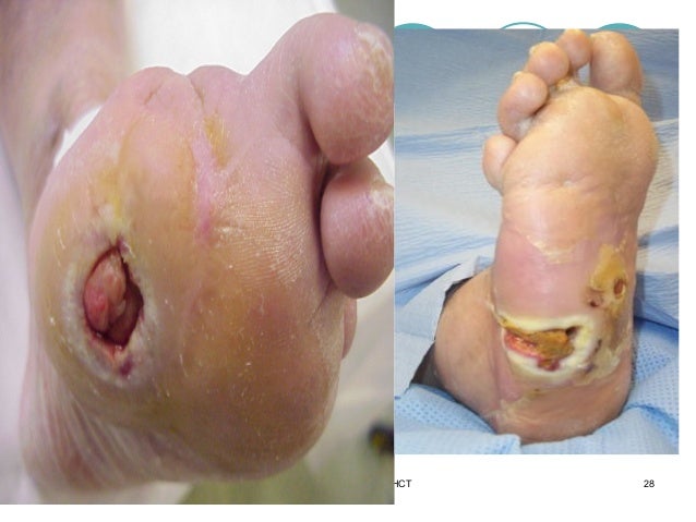 Foot Infection Symptoms & Treatment Options | Advanced ...