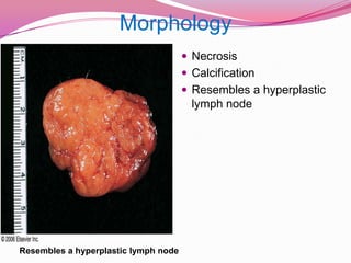 MorphologyNecrosisCalcificationResembles a hyperplastic lymph nodeResembles a hyperplastic lymph node