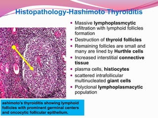 Histopathology-Hashimoto ThyroiditisMassivelymphoplasmcyticinfiltration with lymphoid follicles formation Destruction of thyroid folliclesRemaining follicles are small and many are lined by Hurthle cellsIncreased interstitial connective tissueplasma cells, histiocytesscattered intrafollicular multinucleated giant cellsPolyclonal lymphoplasmacytic populationashimoto's thyroiditis showing lymphoid follicles with prominent germinal centers and oncocytic follicular epithelium.