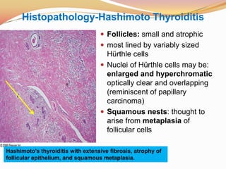 Histopathology-Hashimoto ThyroiditisFollicles: small and atrophicmost lined by variably sized Hürthle cellsNuclei of Hürthle cells may be: enlarged and hyperchromaticoptically clear and overlapping (reminiscent of papillary carcinoma)Squamous nests: thought to arise from metaplasia of follicular cellsHashimoto's thyroiditis with extensive fibrosis, atrophy of follicular epithelium, and squamous metaplasia.