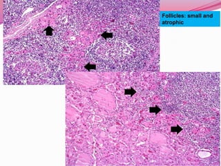 Follicles: small and atrophic