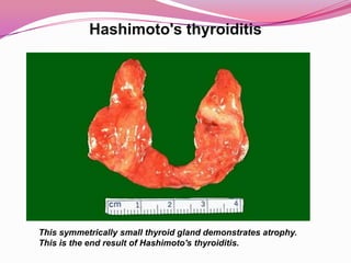 Hashimoto's thyroiditisThis symmetrically small thyroid gland demonstrates atrophy. This is the end result of Hashimoto's thyroiditis.