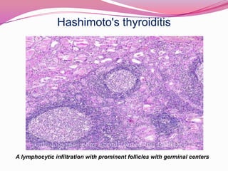 Hashimoto's thyroiditisA lymphocytic infiltration with prominent follicles with germinal centers
