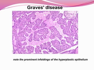Graves' diseaseThe most common cause of hyperthyrodismIt is an autoimmune  disorder. where the thyroid is overactive, producing an excessive amount of thyroid hormones (a serious metabolic imbalance known as hyperthyroidism and thyrotoxicosis)More common in young adults.Can be familial and associated with other autoimmune diseasesThe resulting is a dramatic constellation of neuropsychological and physical signs and symptoms.Characterized by hyperthyroidism, ophthalmopathy with exophthalmos and dermopathy (pretibialmyxedema)