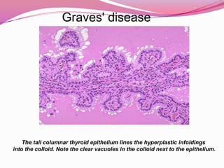Graves’ DiseaseAutoimmune disease with breakdown of helper-T-cell toleranceExcessive production of TWO thyroid autoantibodies: Thyroid-stimulating antibody (TSAb) &Growth-stimulating antibody (GSAb)Antibodies bind to the TSH receptor of the follicular cellStimulation of the cell resulting in:Increased levels of thyroid hormones &Hyperplasia of the thyroid glandHyperthyroidism and Thyroid gland enlargement