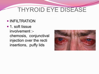 HyperthyrodismClinical features: due toHypermetabolic state Overactivity of sympathetic nervous system