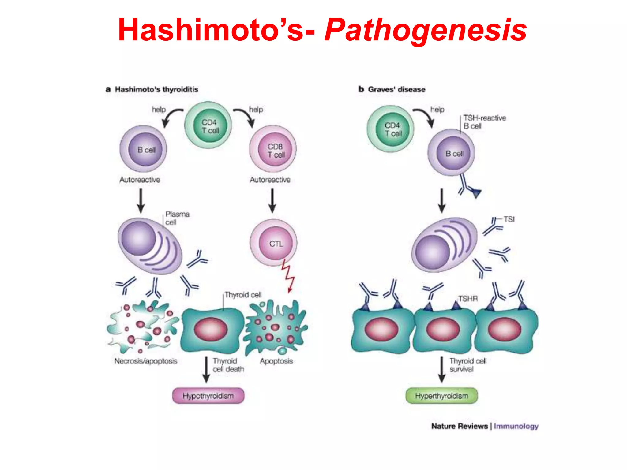 Hashimoto’s- Pathogenesis
 