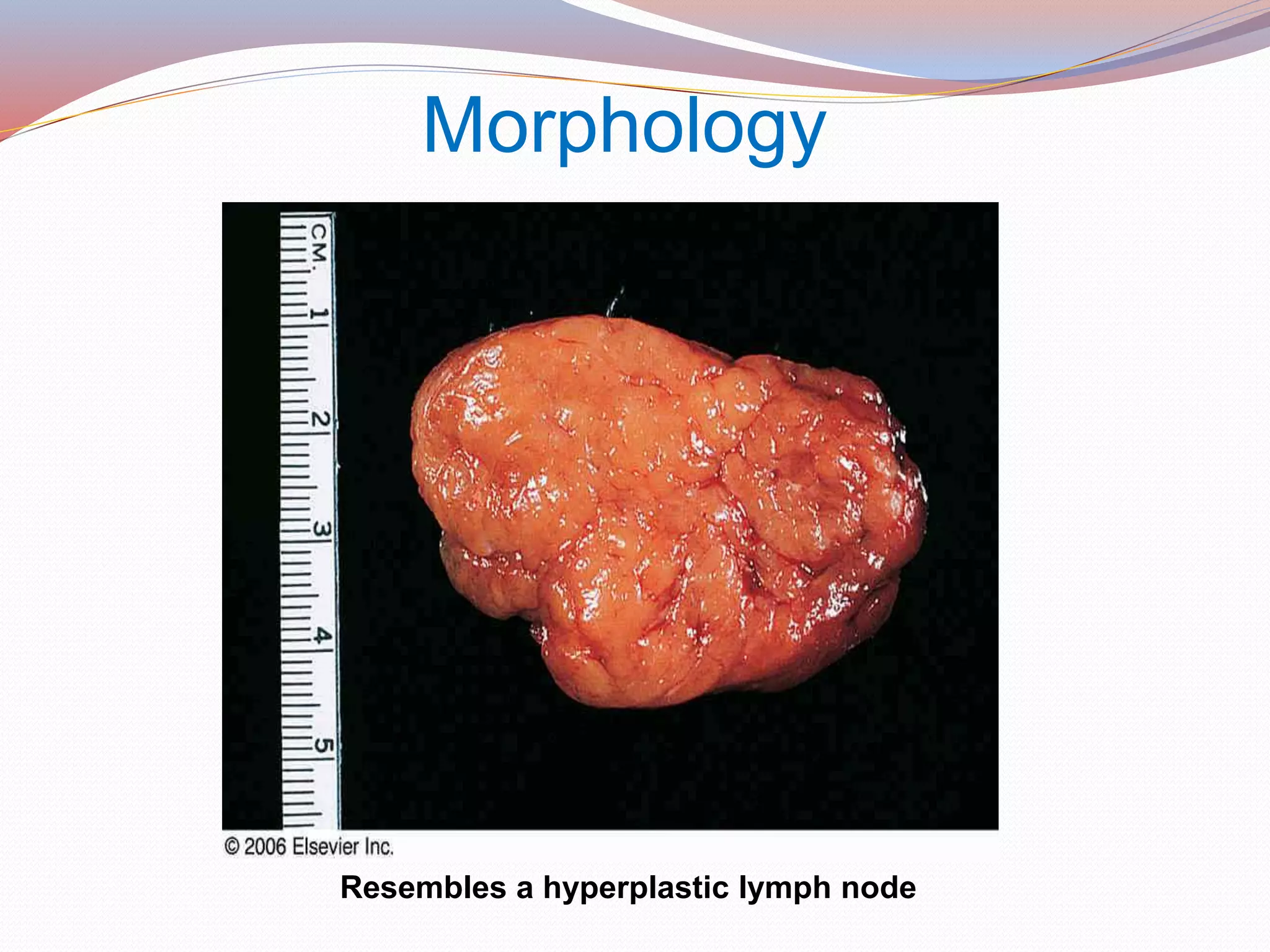 Morphology
Resembles a hyperplastic lymph node
 