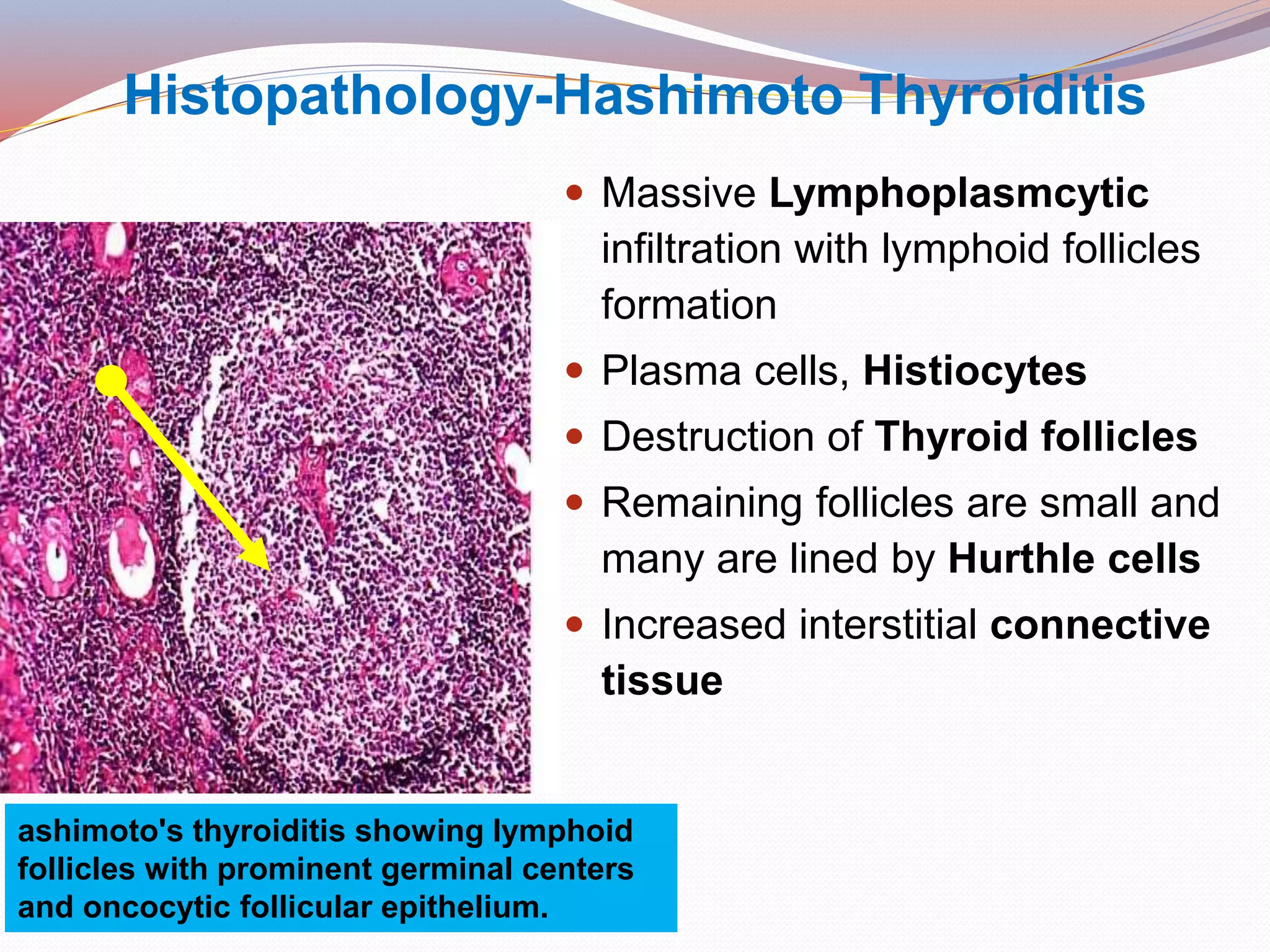 Histopathology-Hashimoto Thyroiditis
 Massive Lymphoplasmcytic
infiltration with lymphoid follicles
formation
 Plasma cells, Histiocytes
 Destruction of Thyroid follicles
 Remaining follicles are small and
many are lined by Hurthle cells
 Increased interstitial connective
tissue
ashimoto's thyroiditis showing lymphoid
follicles with prominent germinal centers
and oncocytic follicular epithelium.
 