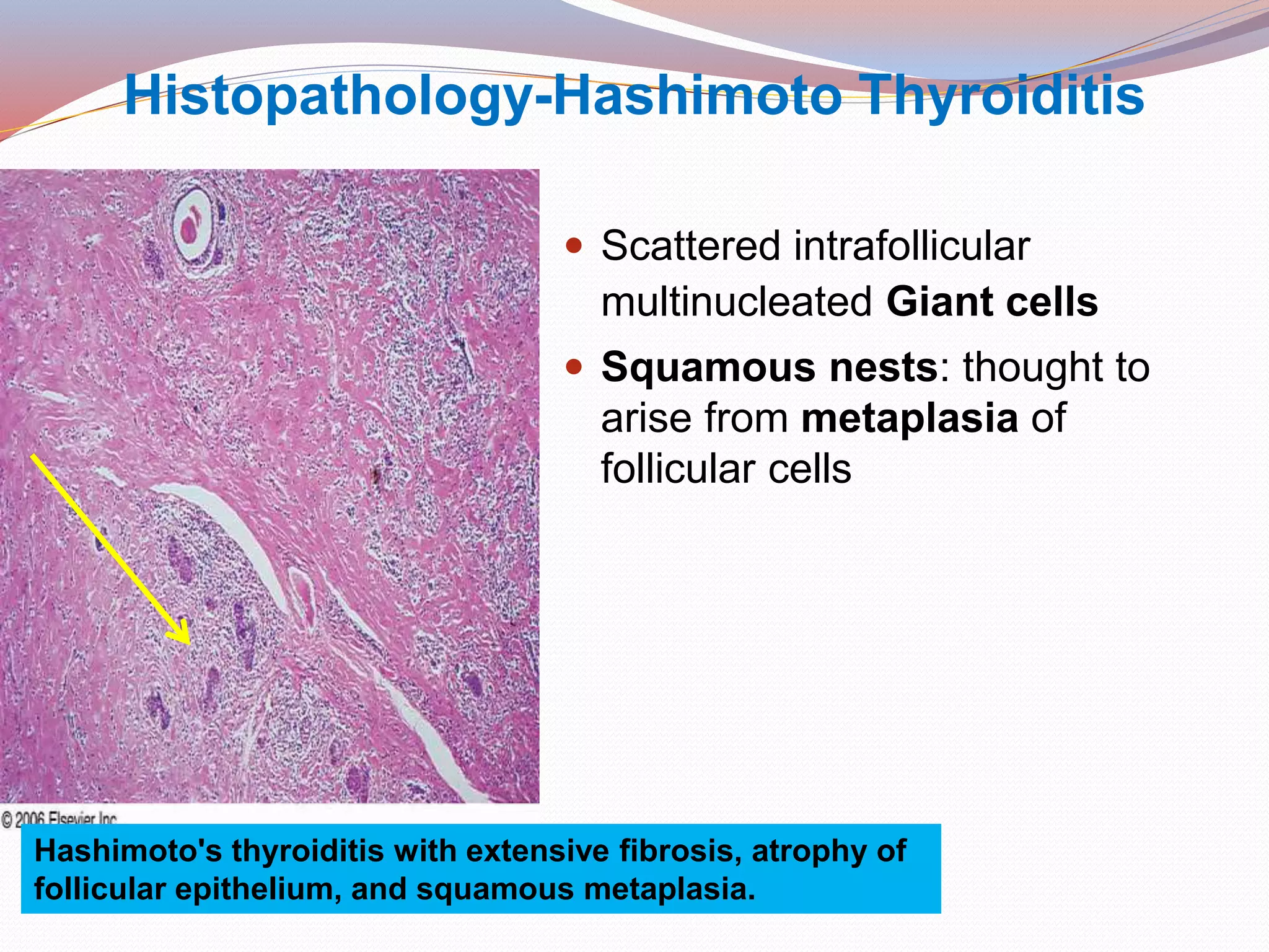Histopathology-Hashimoto Thyroiditis
 Scattered intrafollicular
multinucleated Giant cells
 Squamous nests: thought to
arise from metaplasia of
follicular cells
Hashimoto's thyroiditis with extensive fibrosis, atrophy of
follicular epithelium, and squamous metaplasia.
 