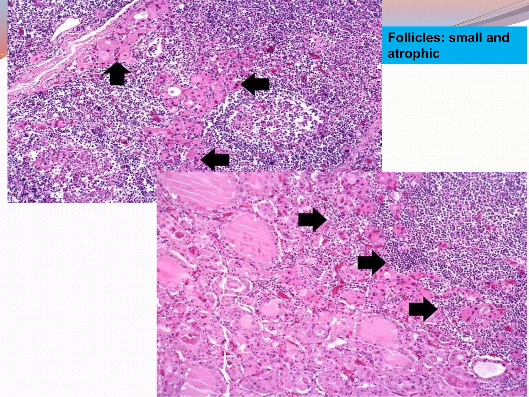 Follicles: small and
atrophic
 