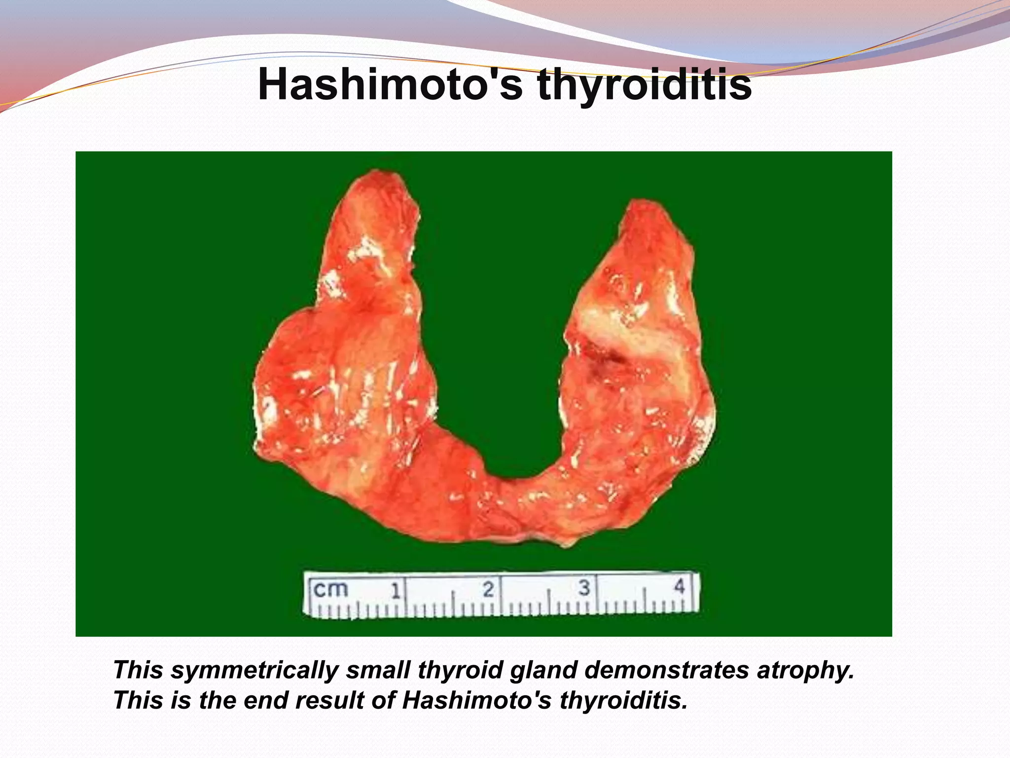 Hashimoto's thyroiditis
This symmetrically small thyroid gland demonstrates atrophy.
This is the end result of Hashimoto's thyroiditis.
 