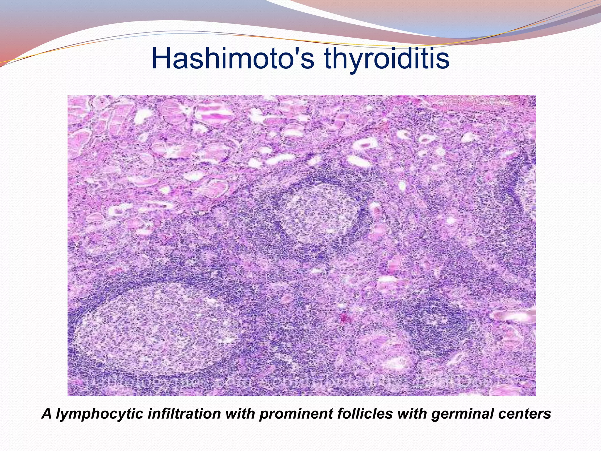 Hashimoto's thyroiditis
A lymphocytic infiltration with prominent follicles with germinal centers
 