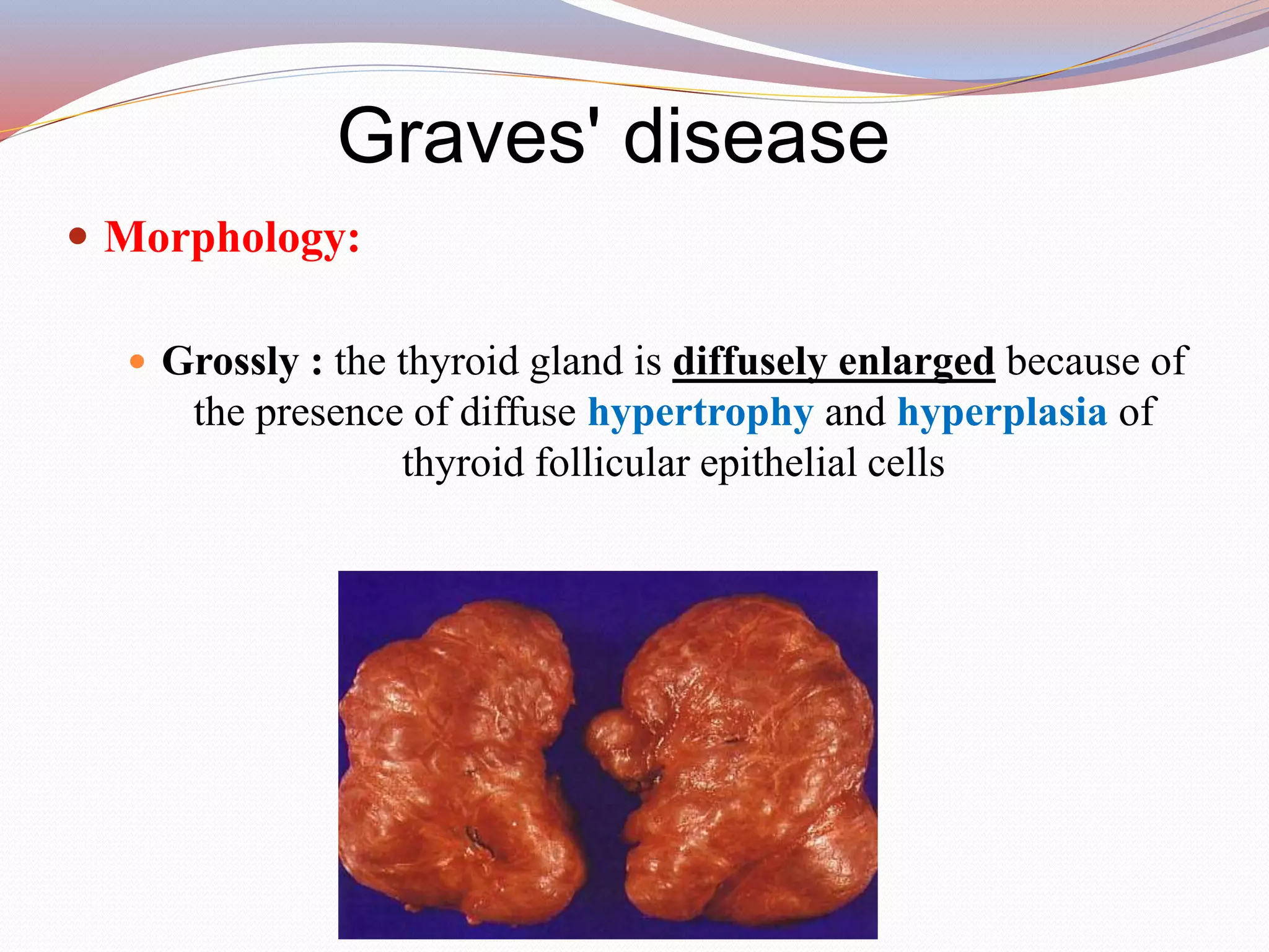 Graves' disease
 Morphology:
 Grossly : the thyroid gland is diffusely enlarged because of
the presence of diffuse hypertrophy and hyperplasia of
thyroid follicular epithelial cells
 