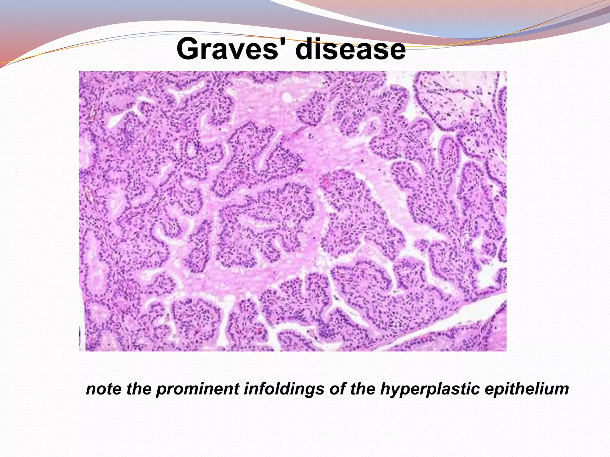 Graves' disease
note the prominent infoldings of the hyperplastic epithelium
 