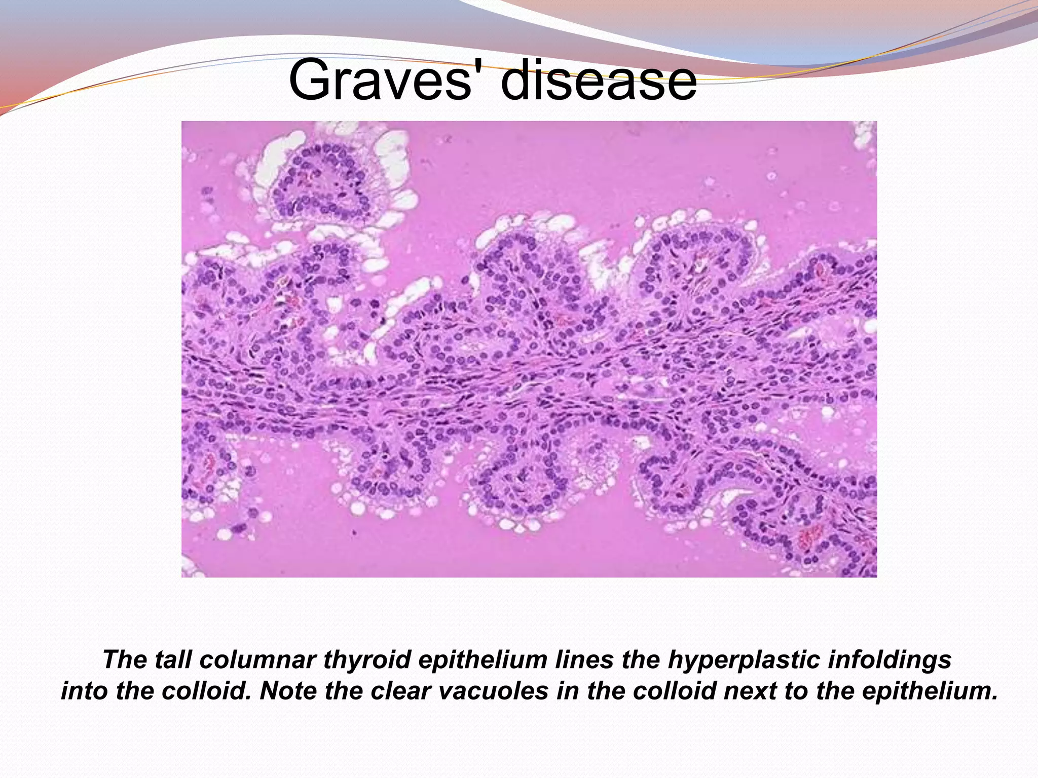 Graves' disease
The tall columnar thyroid epithelium lines the hyperplastic infoldings
into the colloid. Note the clear vacuoles in the colloid next to the epithelium.
 