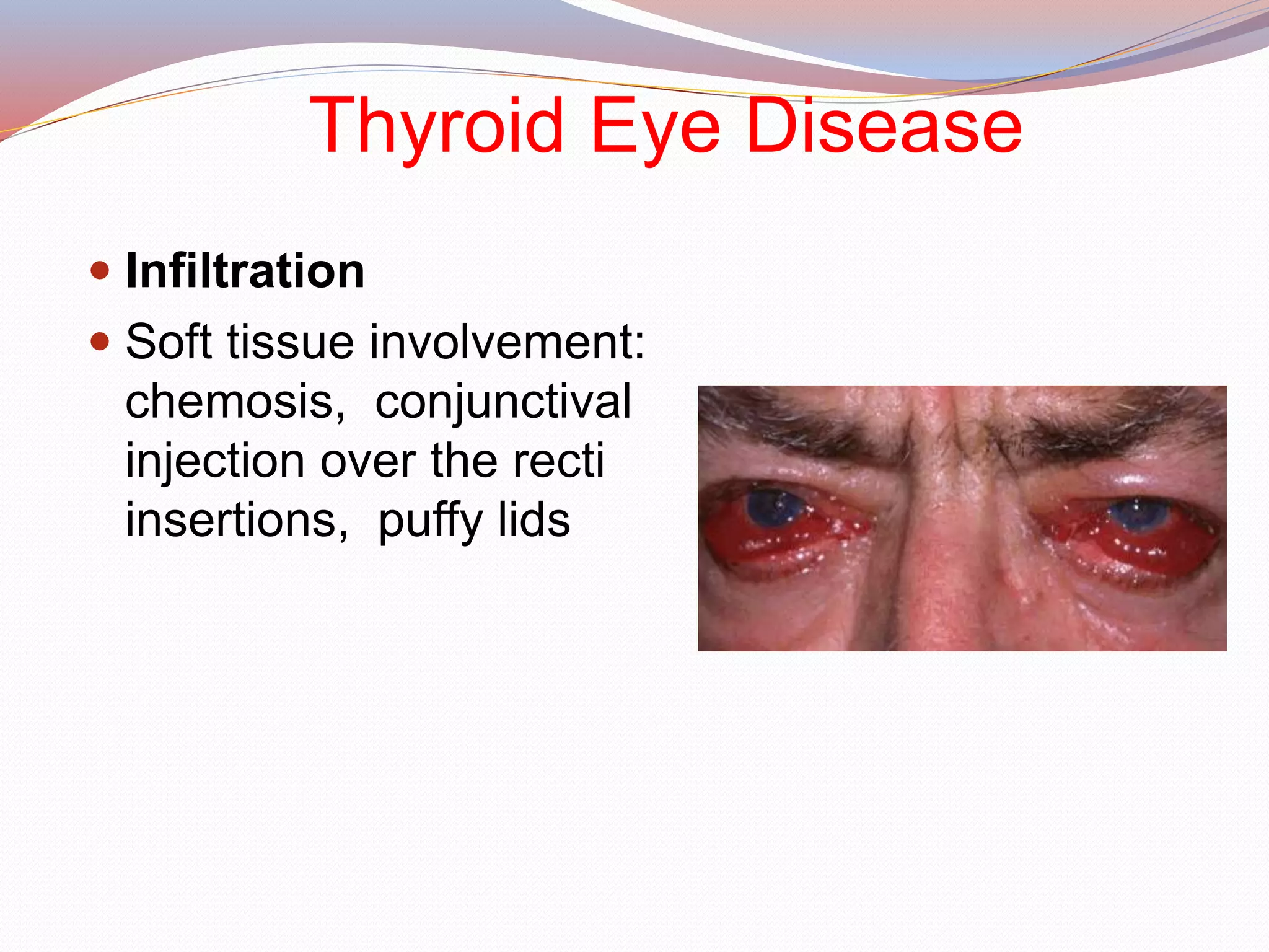 Thyroid Eye Disease
 Infiltration
 Soft tissue involvement:
chemosis, conjunctival
injection over the recti
insertions, puffy lids
 