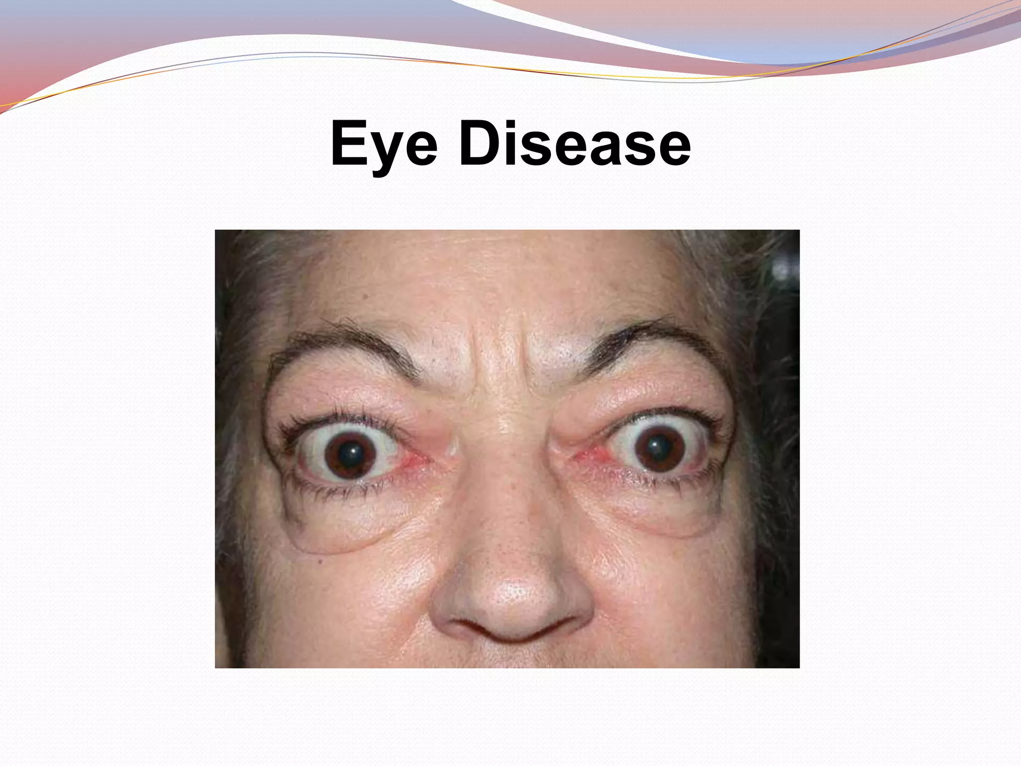 Eye Disease
 