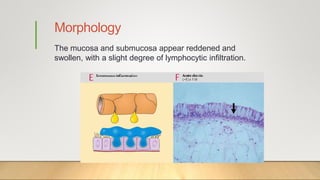 Morphology
The mucosa and submucosa appear reddened and
swollen, with a slight degree of lymphocytic infiltration.
 