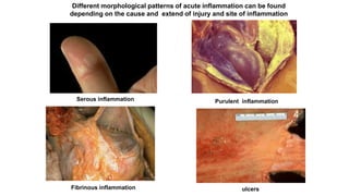 Different morphological patterns of acute inflammation can be found
depending on the cause and extend of injury and site of inflammation
Serous inflammation
Fibrinous inflammation
Purulent inflammation
ulcers
 