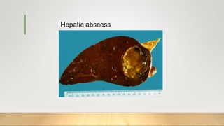 Hepatic abscess
 
