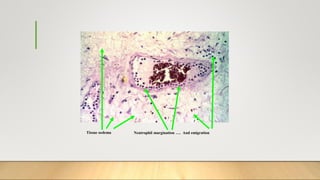 Tissue oedema Neutrophil margination …. And emigration
 