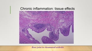 Chronic inflammation: tissue effects
Knee joint in rheumatoid arthritis
 